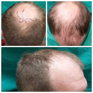 Greg's Pre-NeoGraft Photos