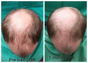 1 month post Greg