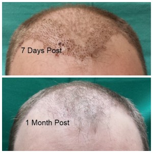 1 Month Post NeoGraft