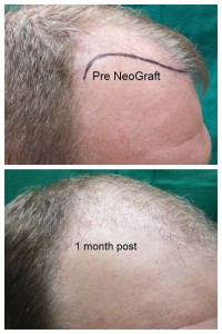 1 month post Greg side
