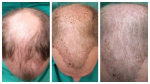 Pre NeoGraft, Day #7 Post, Day #14 Post
