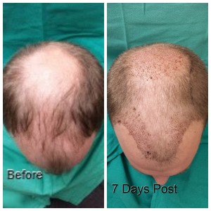 Before 7 Days Post