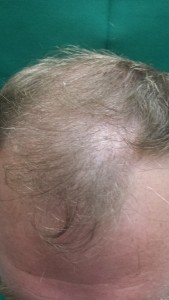 4 mos post NeoGraft